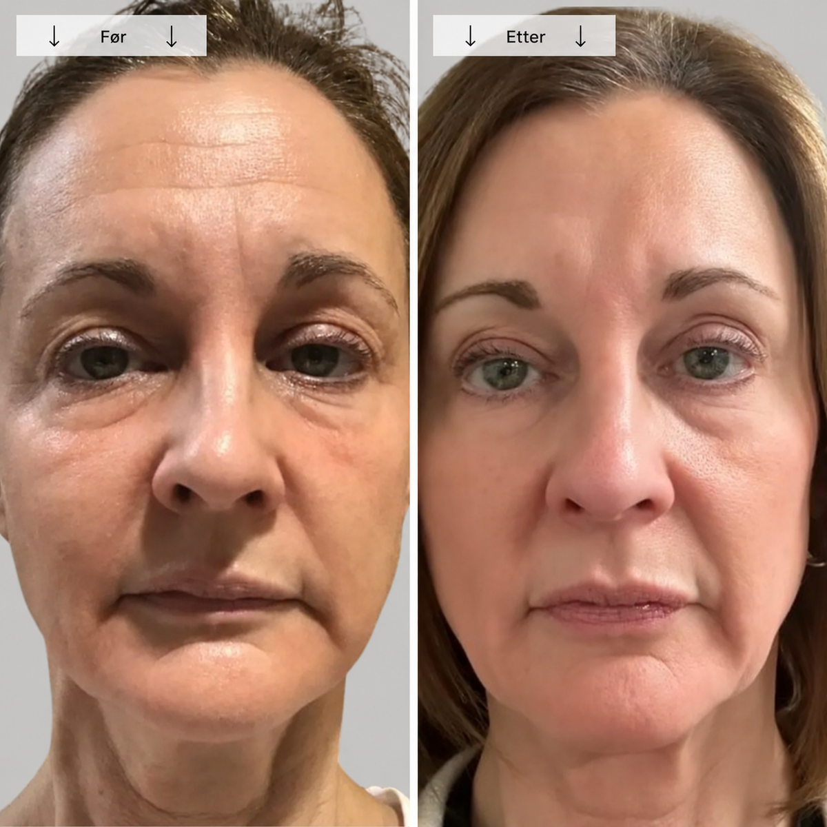 Beautyform® Nordglow Contour